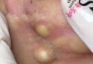 Professional Blackhead Removal & Whitehead Extraction | Deep Pore Cleaning