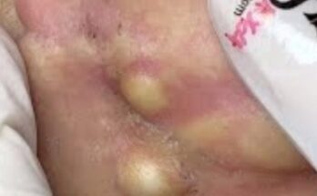 Professional Blackhead Removal & Whitehead Extraction | Deep Pore Cleaning