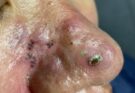 Satisfying Solar Comedone Extraction