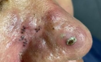 Satisfying Solar Comedone Extraction