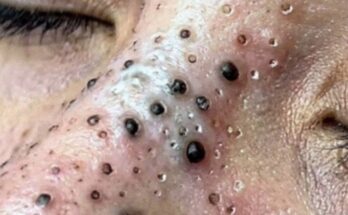 The Nose Knows! Satisfying Blackhead Extractions from Mr. Wilson