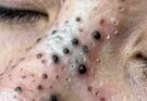 Dr. Pimple Popper Tackles a Stomach Full of Steatocystomas!